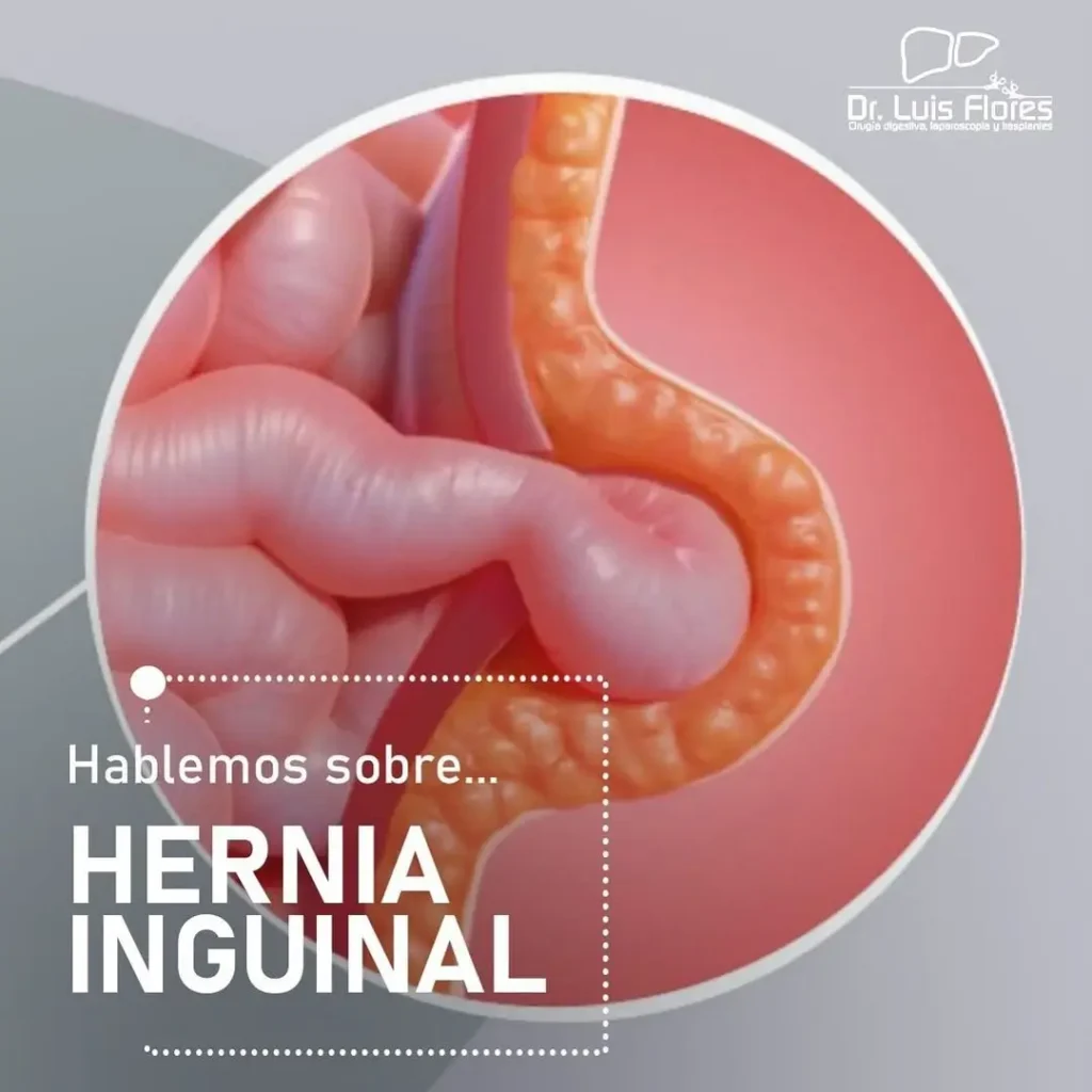 Inguinal Hernia in Cuenca