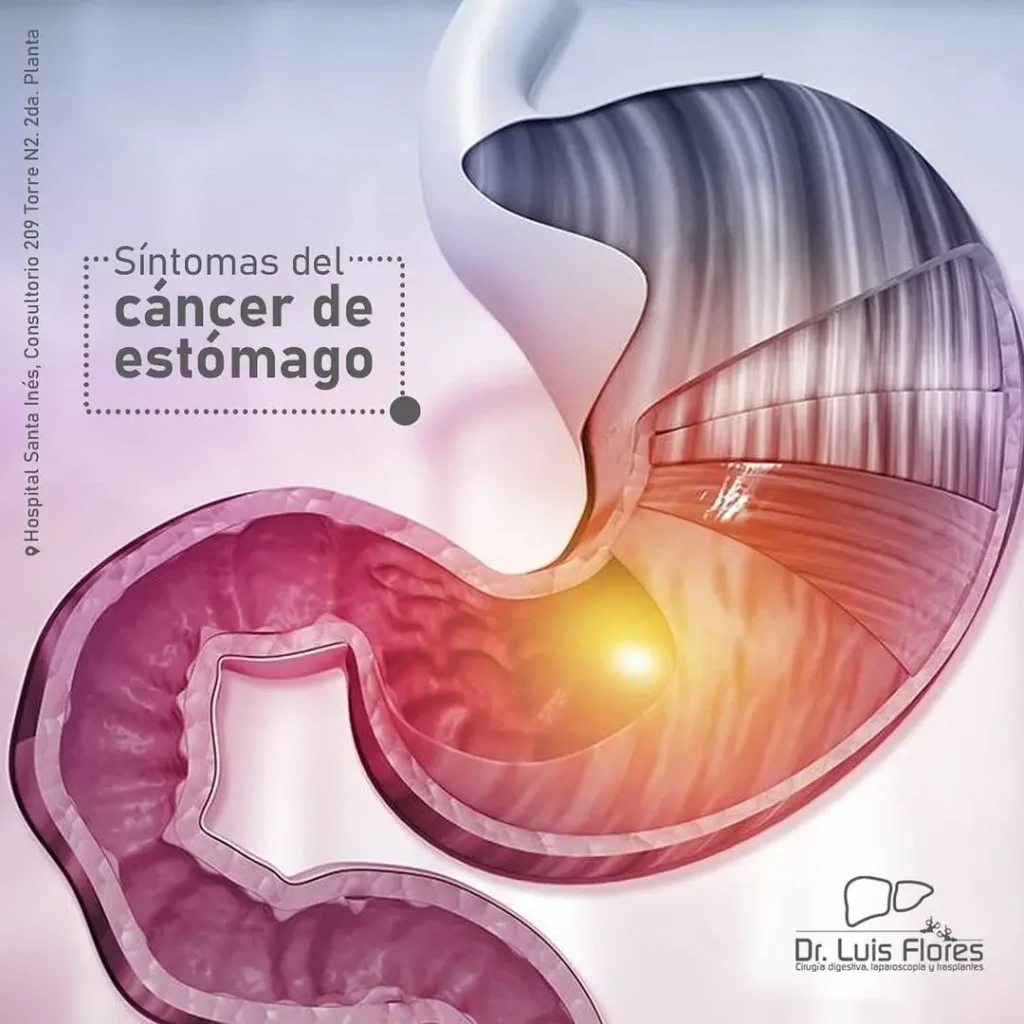 Cáncer de Estomago