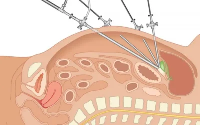 Cirugía Digestiva en Ecuador: Dr. Luis Flores