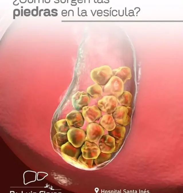 ¿Cómo surgen las piedras en la vesícula?