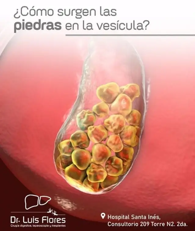 piedras en la vesícula, Dr. Luis Flores - Cirujano General en Cuenca