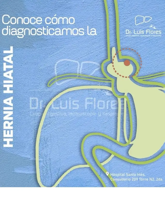Coomo diagnosticamos la hernia hiatal Diagnóstico Hernia Hiatal- Dr. Luis Flores en Cuenca - Ecuador