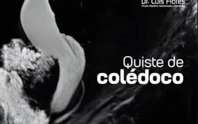¿Qué es un quiste de colédoco?