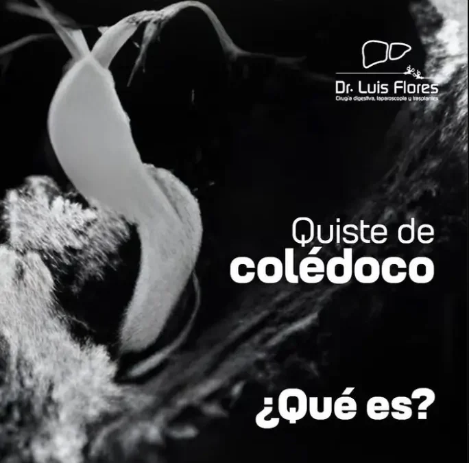 ¿Qué es un quiste de colédoco?