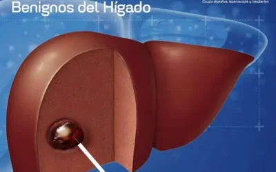Todo sobre tumores benignos del hígado