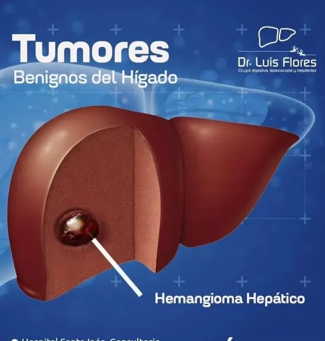 Todo sobre tumores benignos del hígado