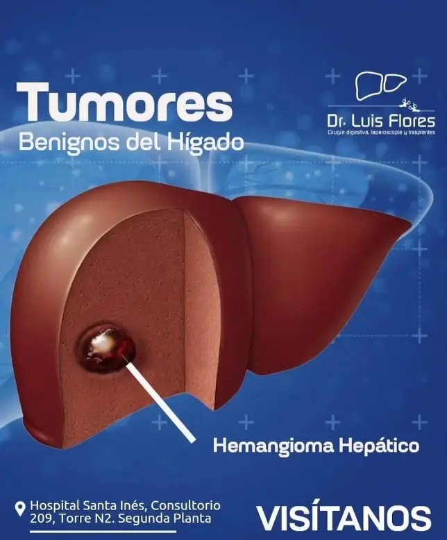tumores benignos del hígado, Dr. Flores en la ciudad de Cuenca - Ecuador.