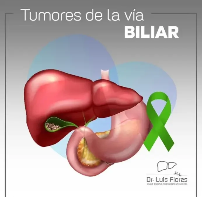 Todo sobre tumores de la vía biliar