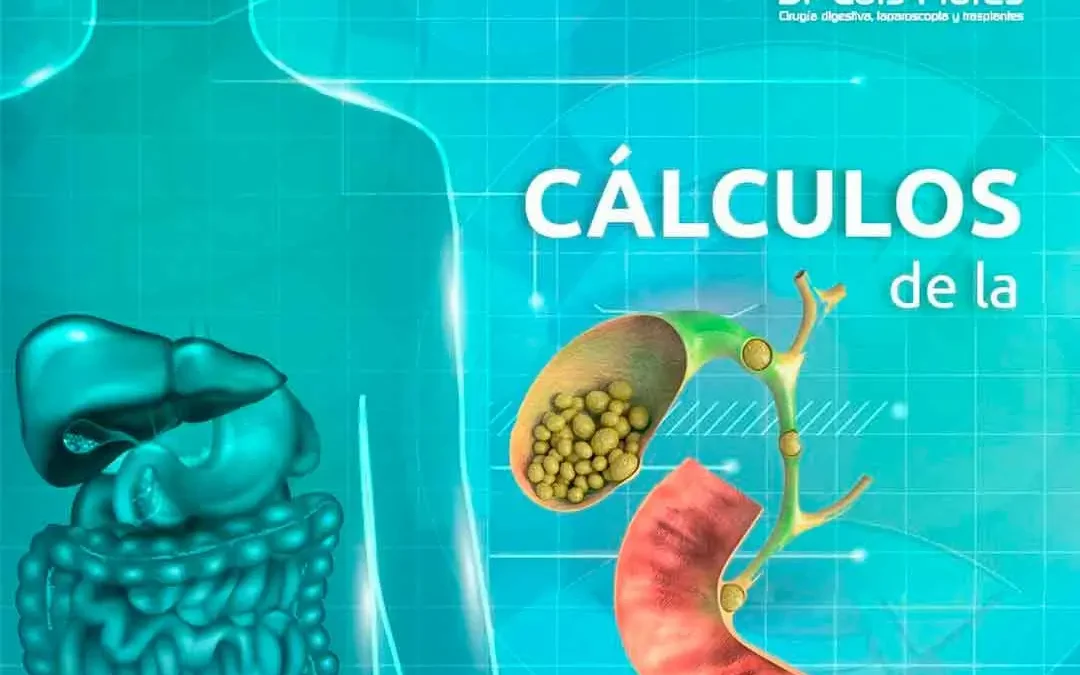 ¿Qué Causa los Cálculos Biliares y Cómo Pueden Afectar tu Salud?