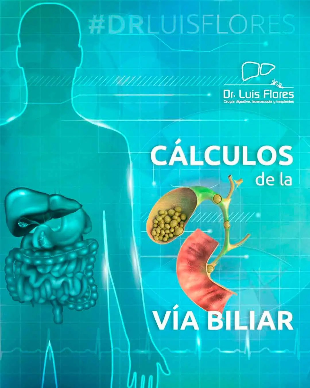 cálculos biliares, Dr. Flores especialista en Cirugía digestiva en la ciudad de Cuenca- Ecuador