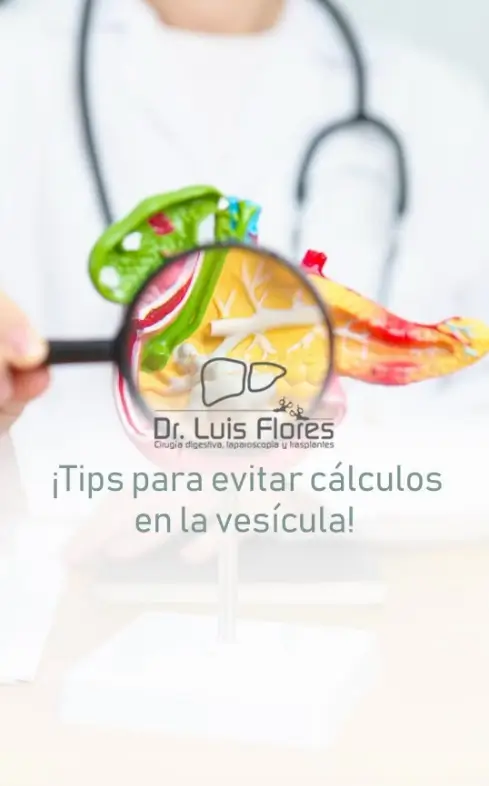 Cálculos en la vesícula