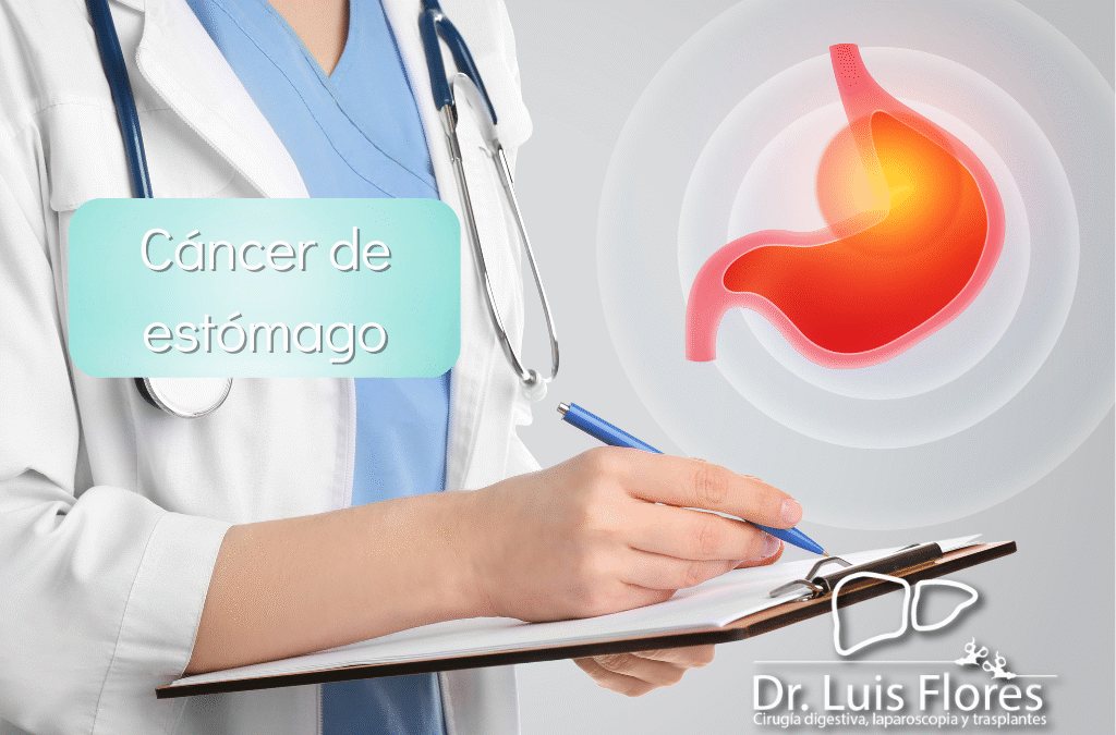Cáncer de Estómago en Cuenca