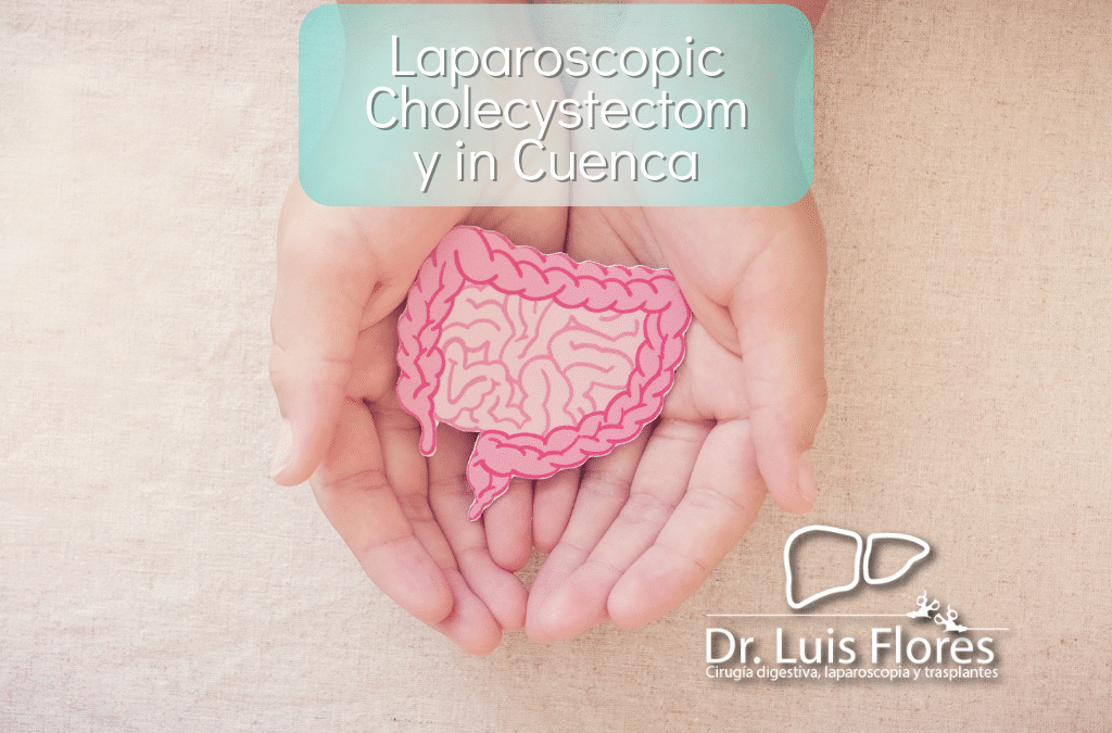 Laparoscopic Cholecystectomy in Cuenca