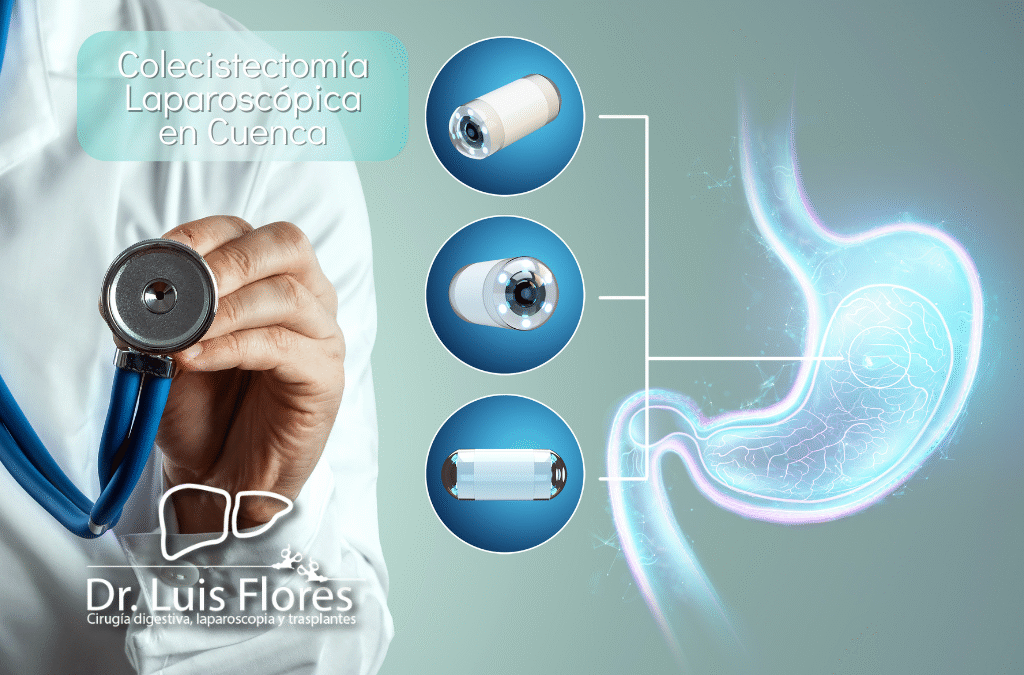 ¿Qué es una Colecistectomía Laparoscópica Detallada?