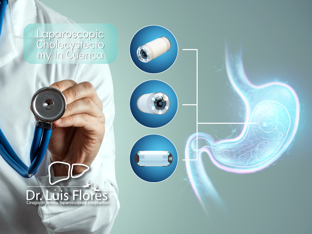 Detailed Laparoscopic Cholecystectomy in Cuenca