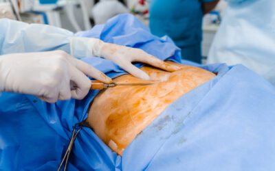 Cirugía Digestiva en Ecuador: Guía Completa para Pacientes