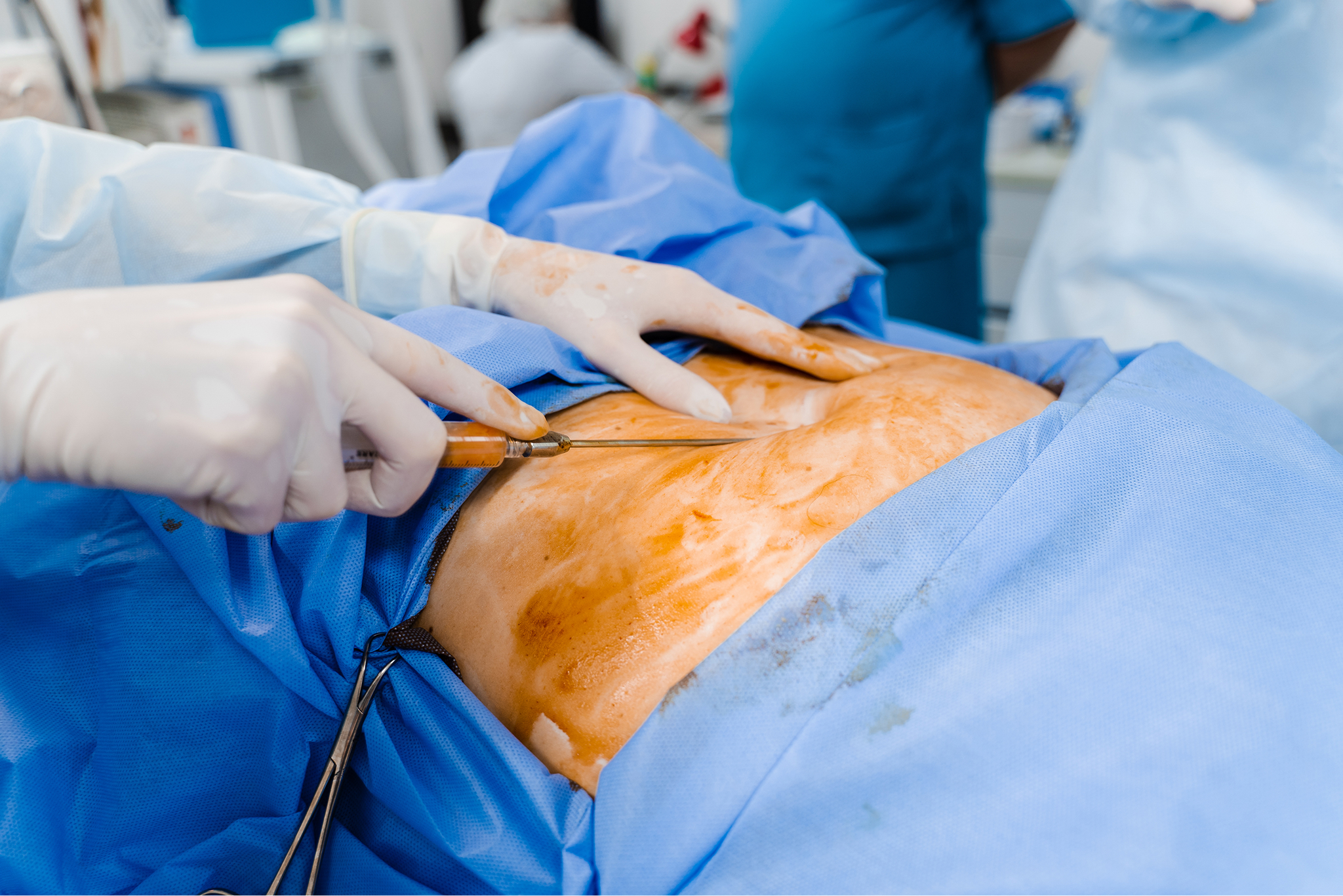 surgeon-removes-belly-fat-abdominoplasty-reduce-ab-2026-02-28-23-51-42-utc 1