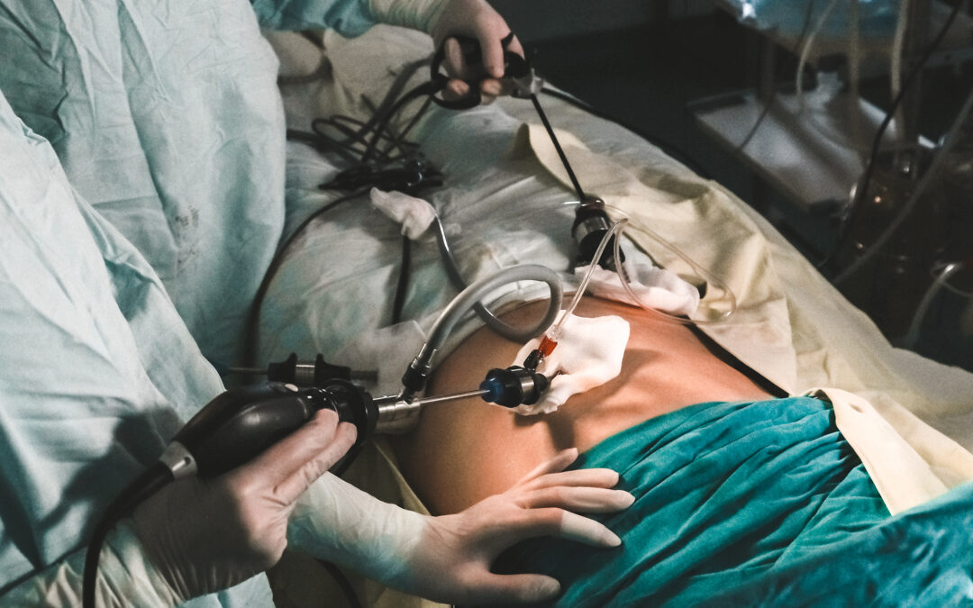 Laparoscopic Stomach Surgery in Cuenca: